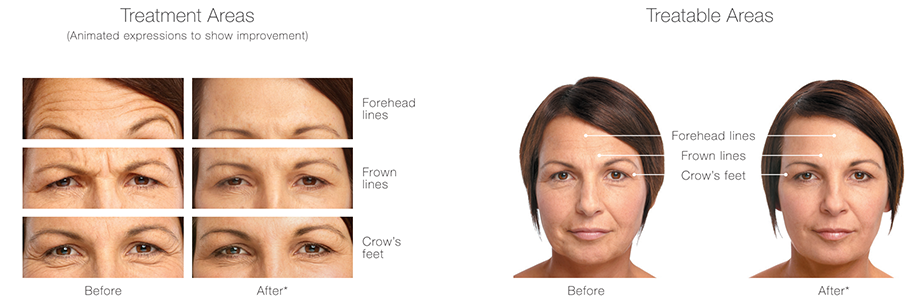 Diagram of Botox treatment