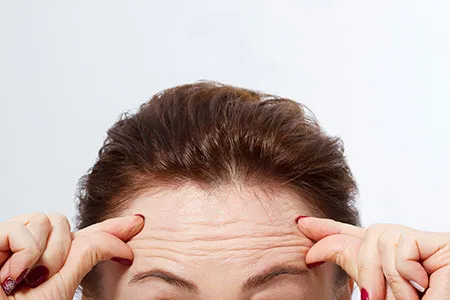 Client forehead with wrinkles